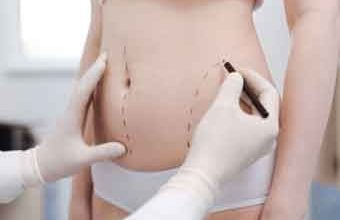 Kalça ve basendeki yağlardan liposuction ile kurtulun