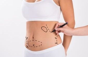 Liposuction uygulaması nedir?